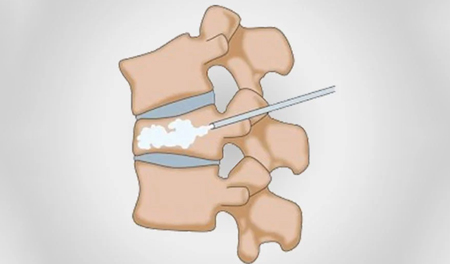 Vertebroplasty / Kyphoplasty
