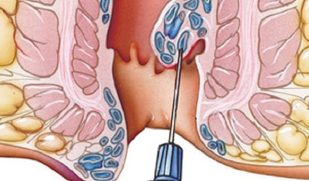 Fissure & Piles (Laser Surgery)