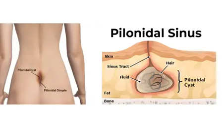 Fistula & Sinus (Laser Surgery)