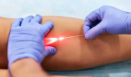 Varicose Vein (Laser Treatment)