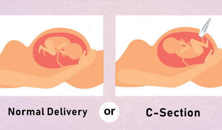 Normal & Cesarean Delivery